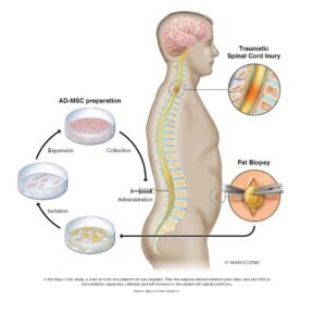 A detailed illustration of how a patient's fat was biopsied with spinal cord injury.